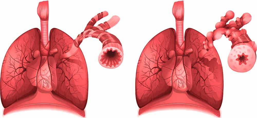 lungs-asthma
